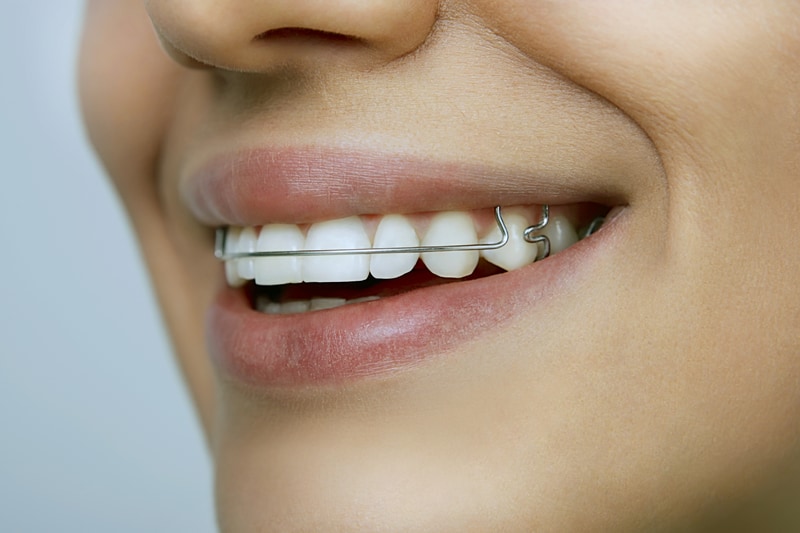 Aparatul dentar – un aliat al unui zambet curat